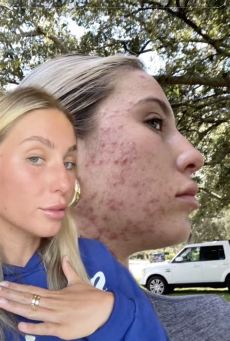 Inside Alix Earles Accutane Journey: The TikTok Star。